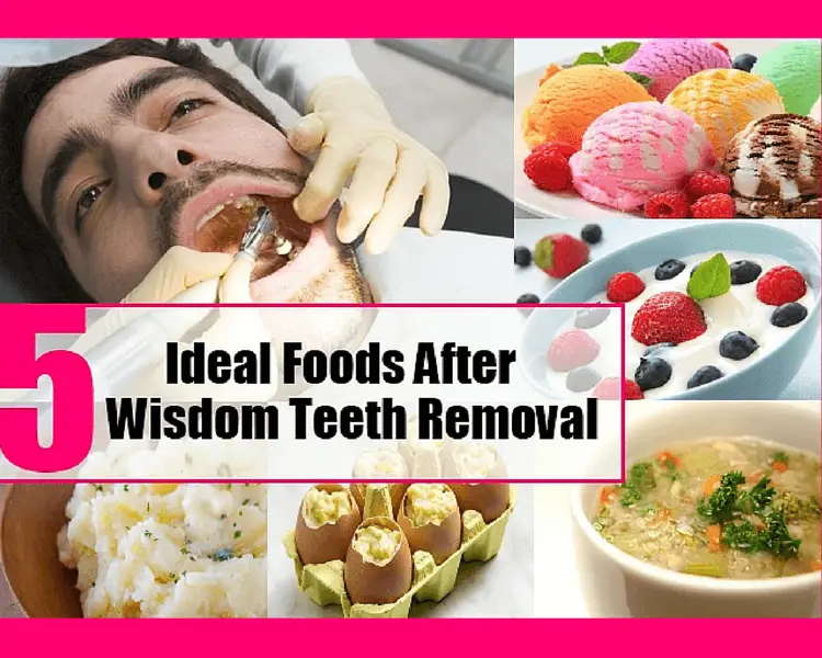 Best Foods to Eat After Tooth Extraction &  Wisdom Tooth ...